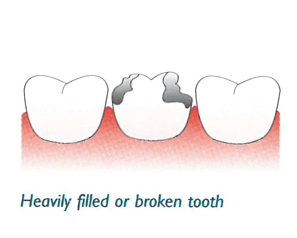 Dental Crown Tawa | Dental Bridges Porirua, Wellington